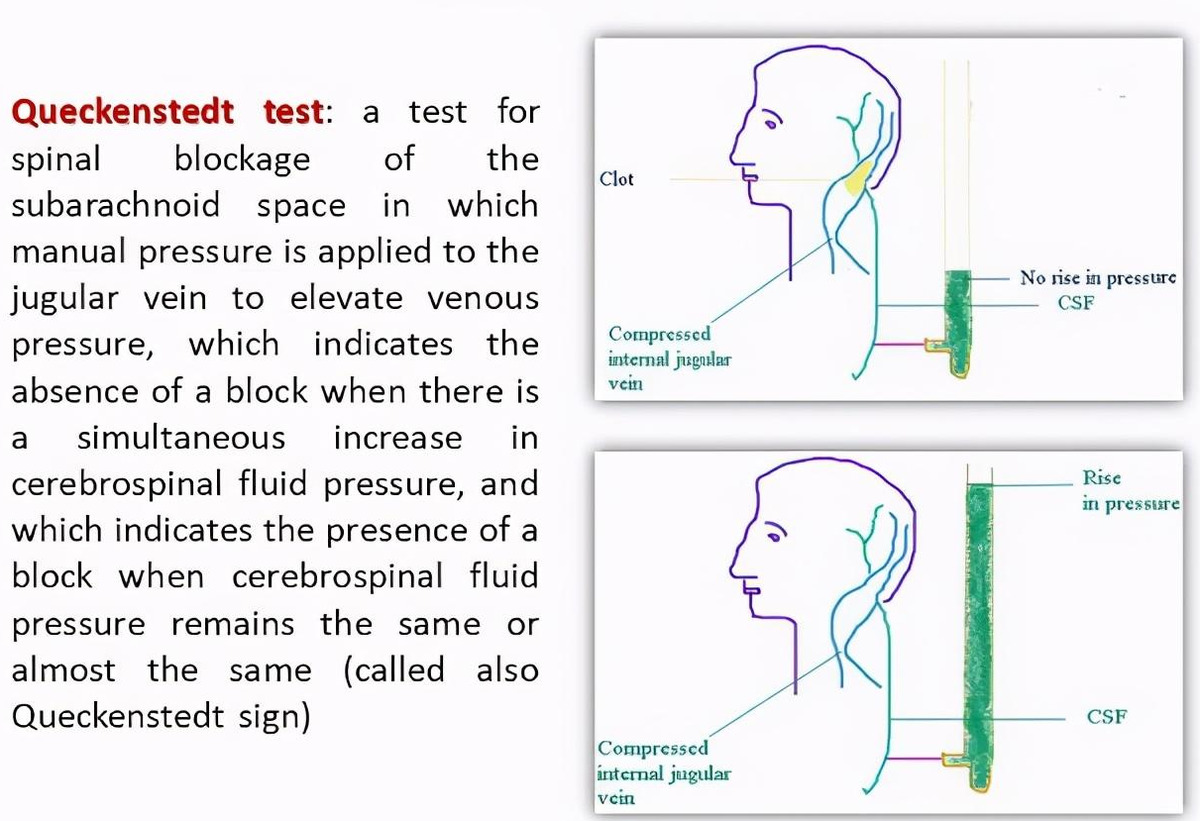 颈静脉压迫试验图片