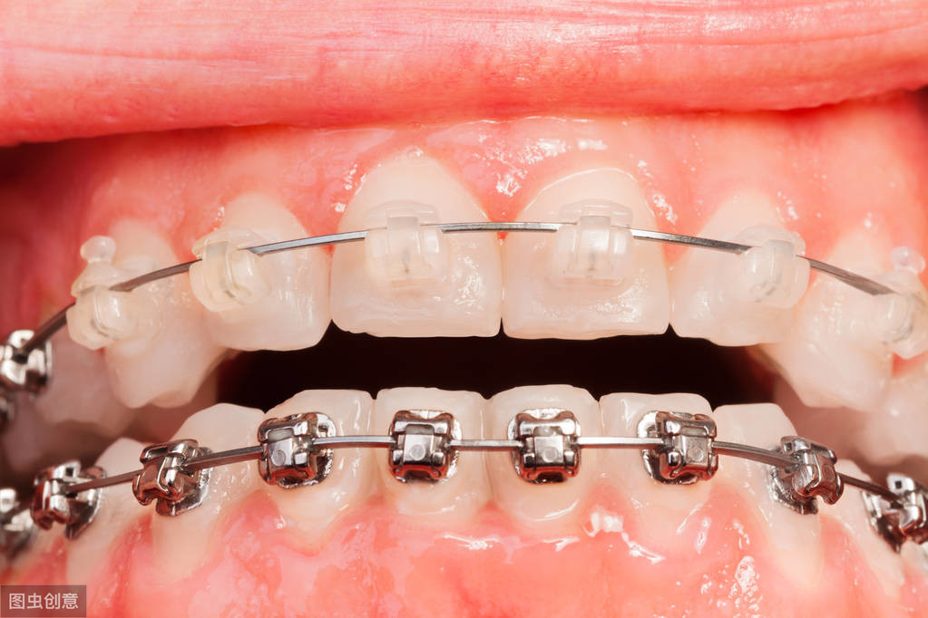 牙齿矫正最低多少钱？