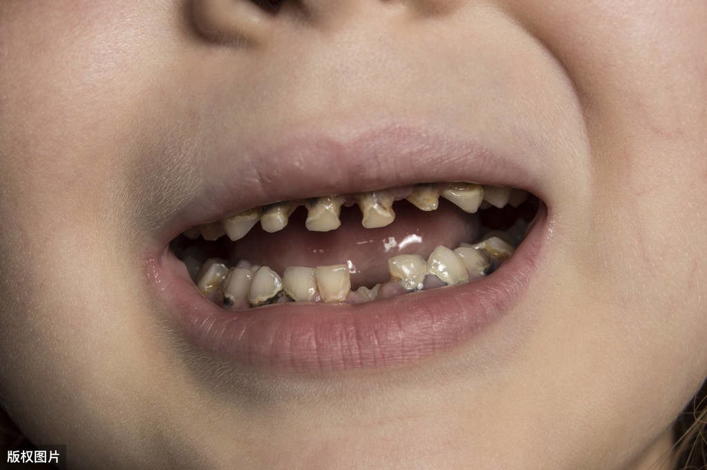 儿童牙釉质发育不全图图片