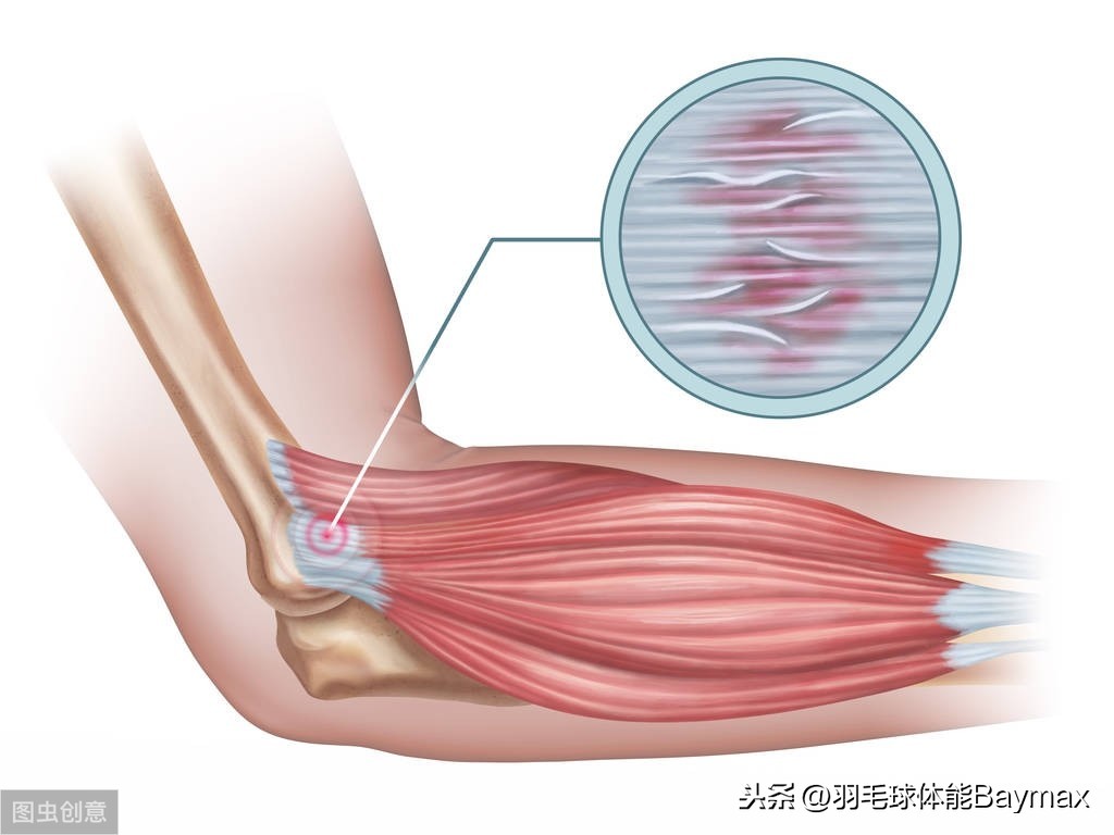 网球肘能按摩吗(1个动作帮你提前发现“网球肘”，4个动作帮你轻松解决它)