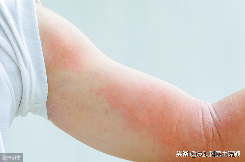 医生，为什么慢性荨麻疹要去检验幽门螺旋杆菌？有必要吗？