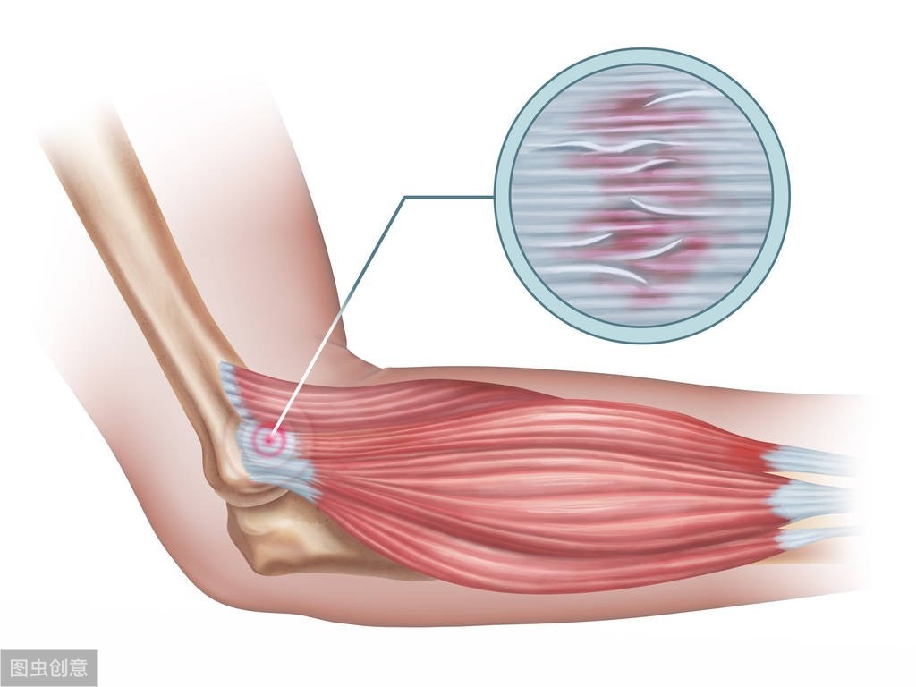 谁做过网球肘手术效果怎么样啊(辟谣｜针灸可以治网球肘吗？存疑！医生：保守治疗90%患者都能康复)