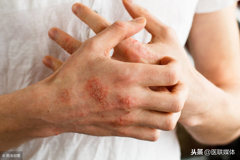 日常如何预防湿疹？这5件事虽小，但起到的作用却不小