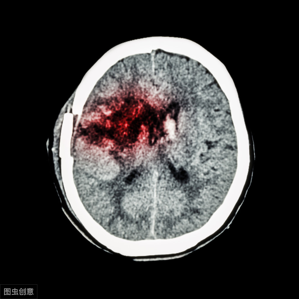 高血压引起出血性脑中，手术该选择哪种方式？医生从专业角度分析