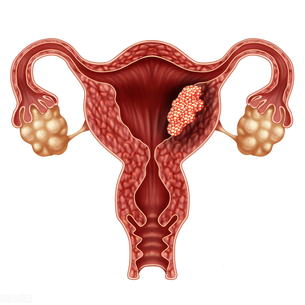 女性子宫内膜炎是怎么检查出来的？怎么调理对恢复好？