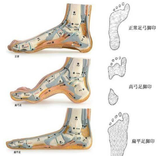 踩网球很酸(导致脚后跟疼的两大病因是什么？如何治疗、康复锻炼，医生告诉您)