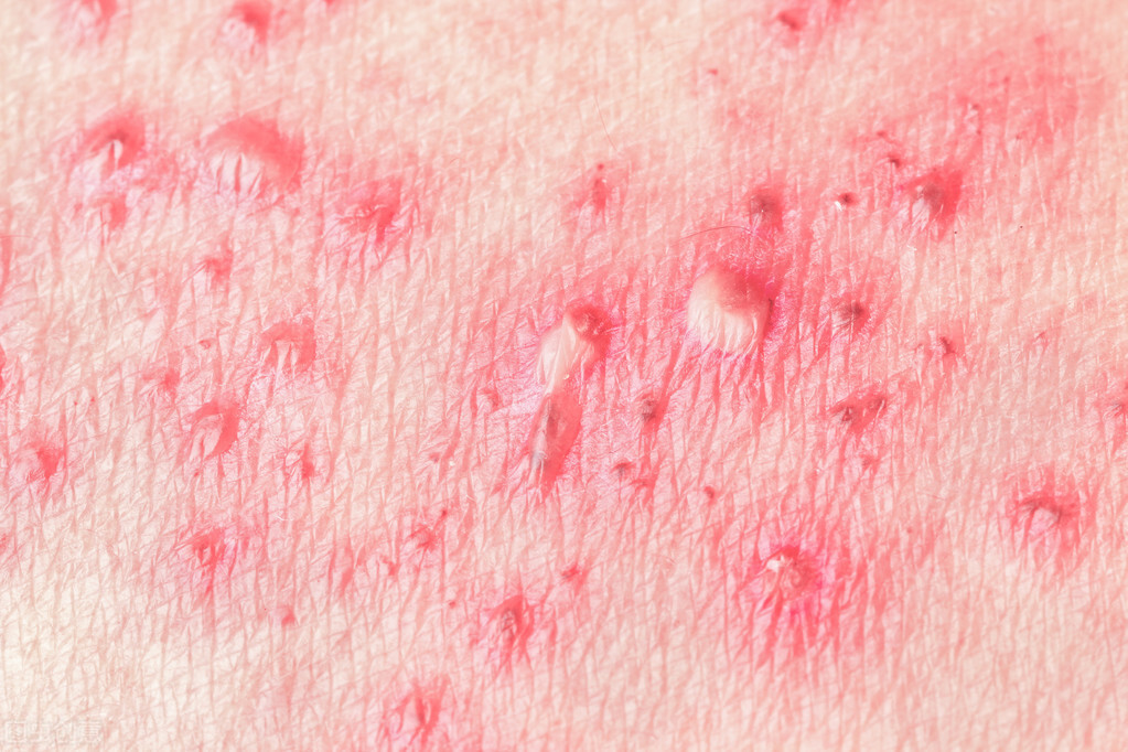 生殖泡疹子的症状图片图片