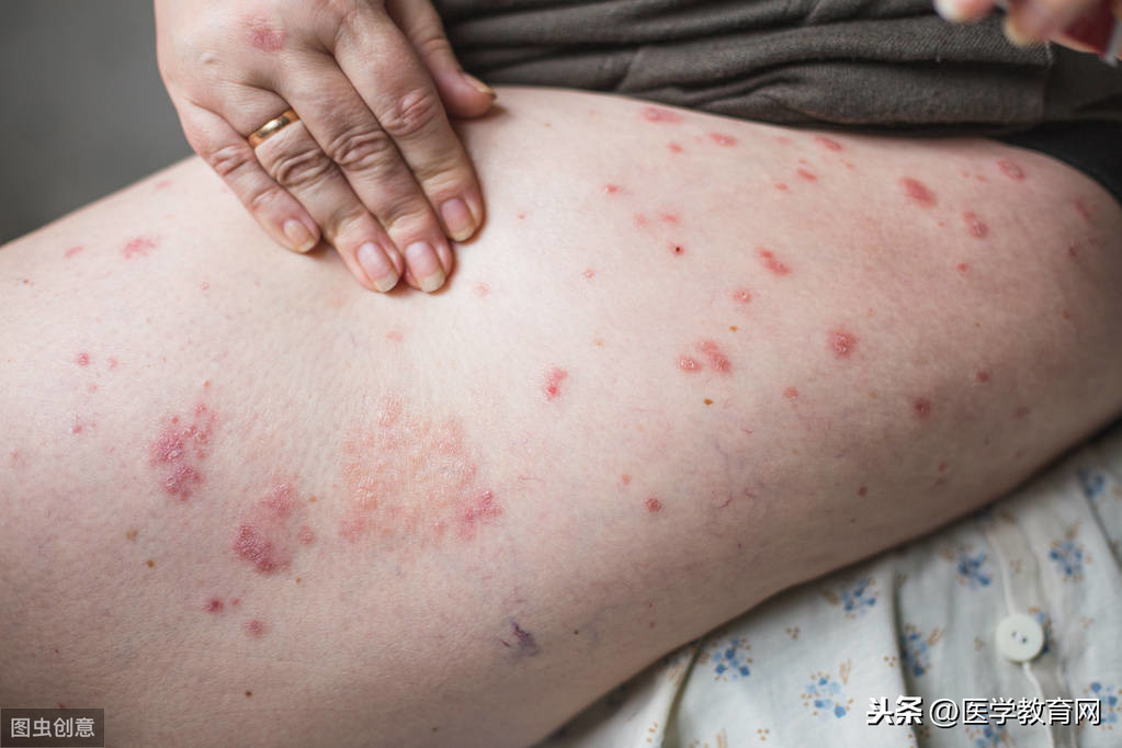 症状与急性荨麻疹相似,但风团颜色较鲜红,皮疹持续时间较长