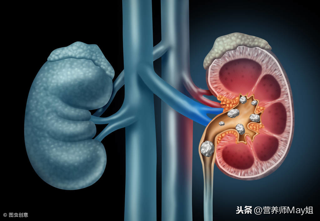 1岁10个月宝宝因补钙得肾结石，营养师告诉你，孩子的钙要这样补