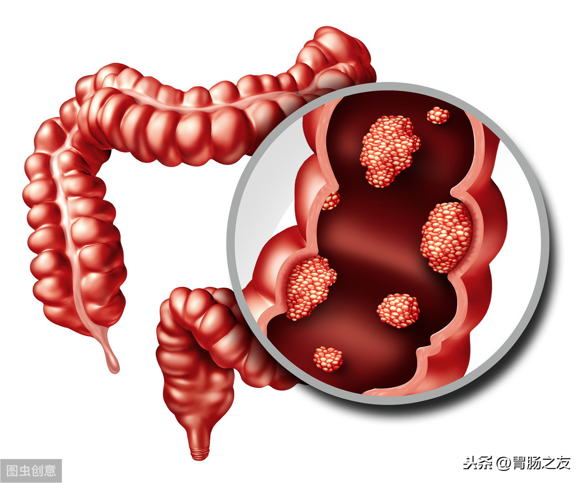 47岁司机在女儿出嫁前夕查出大肠癌，这类肠息肉一定要及时治疗