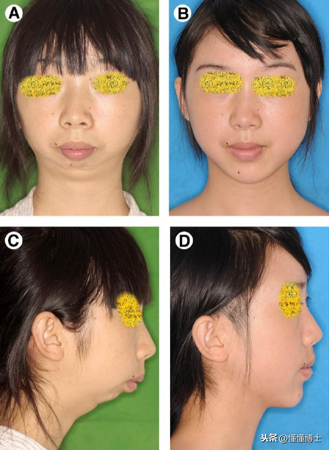 下巴后缩能带给你多大的颜值bug？下巴短和下巴后缩可不一样