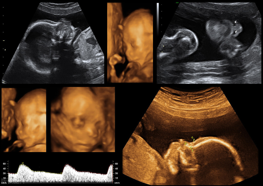 怀孕四周彩超图片图片