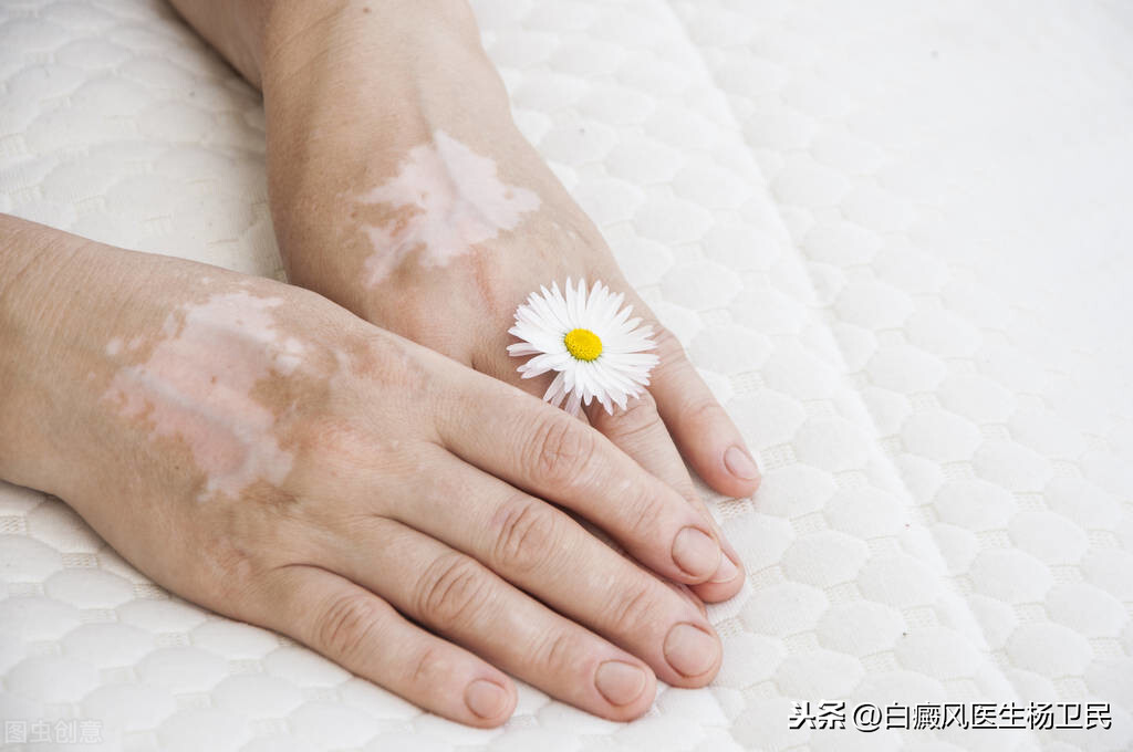 孩子脸上有白斑还起皮是怎么回事？用不用治呢？