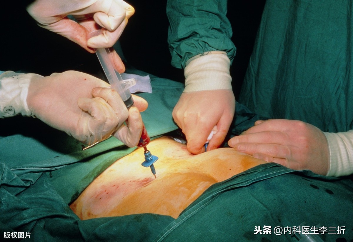 抽骨髓过程图片