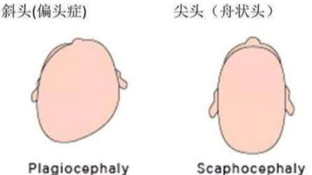 “脑勺高，聪明包”，宝宝头型与智商挂钩？家长们别再被误导了