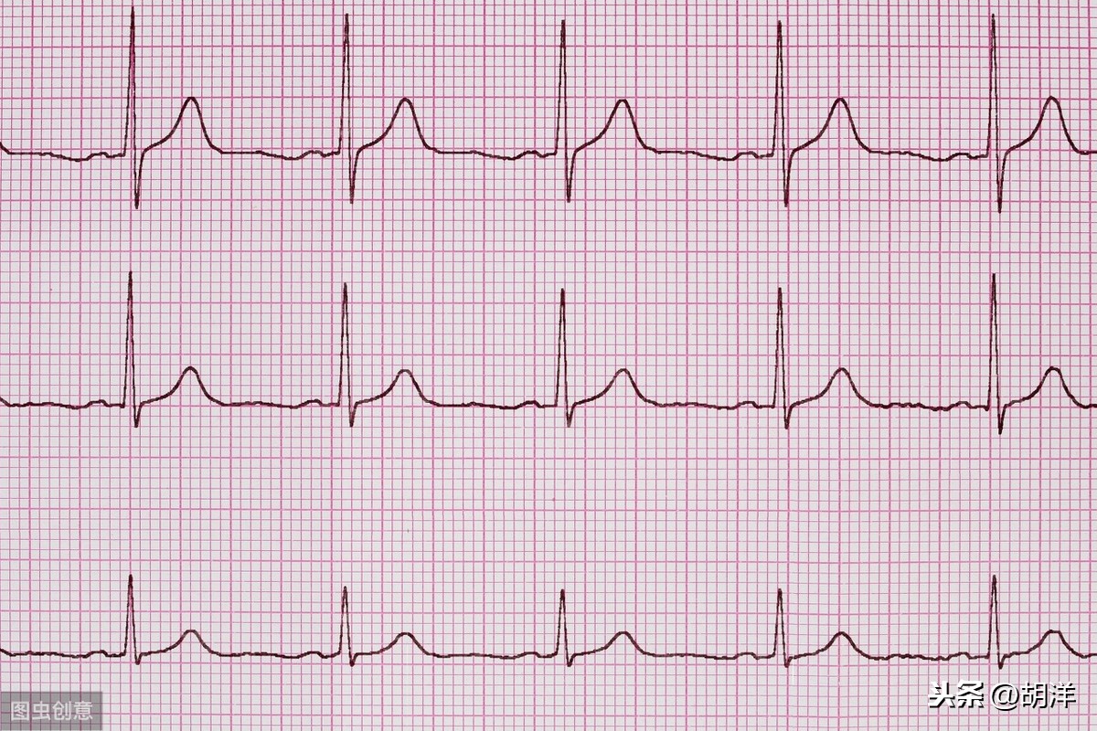 利用心电图机从体表记录心脏每一心动周期所产生的电活动变化图形的