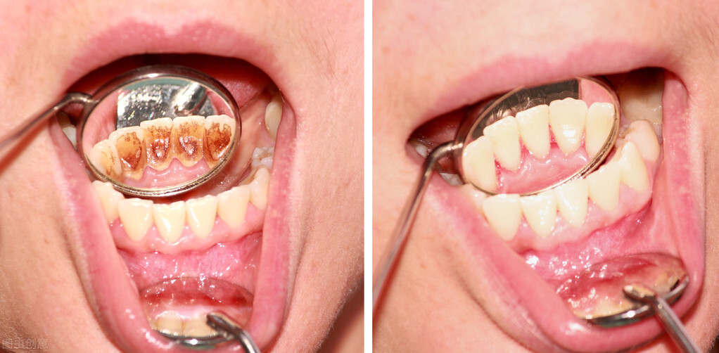 牙龈上长了个瘤子是什么东西?严重吗?