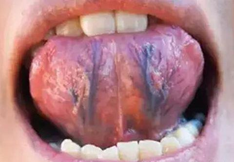 婴儿舌头底下正常图片(舌下有青筋) 