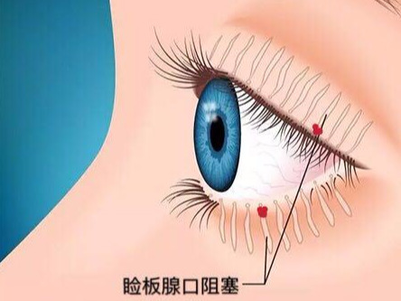 孩子眼皮长包怎么办,眼科医生教您如何区分霰粒肿与麦粒肿