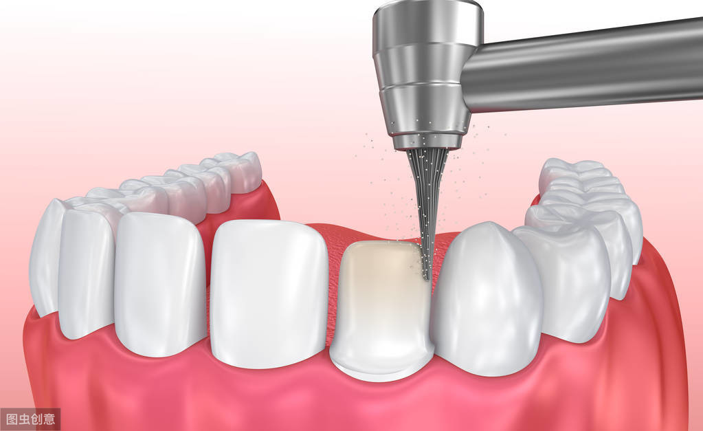 想要牙齿美白，做牙齿贴面好吗？会不会损伤牙齿？看看牙医怎么说