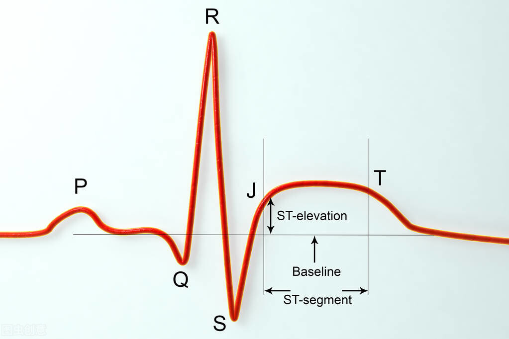 心肌梗死心电图表现有哪些「心肌梗死心电图表现填空题」_友友