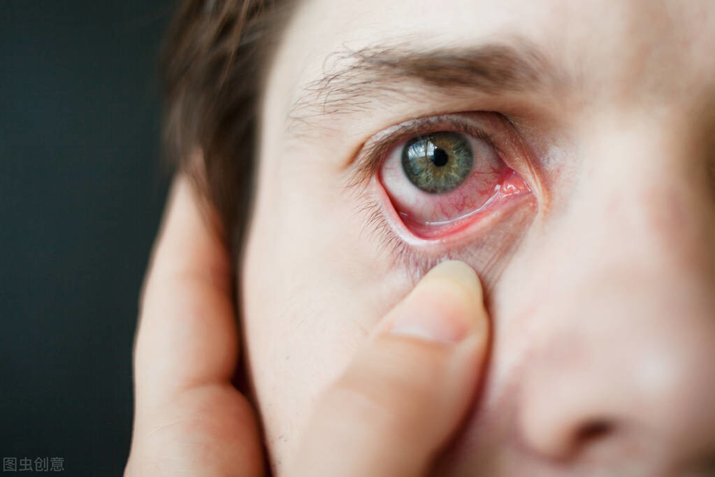 眼睛充血怎么快速消除，眼睛充血快速消除的5个因素？