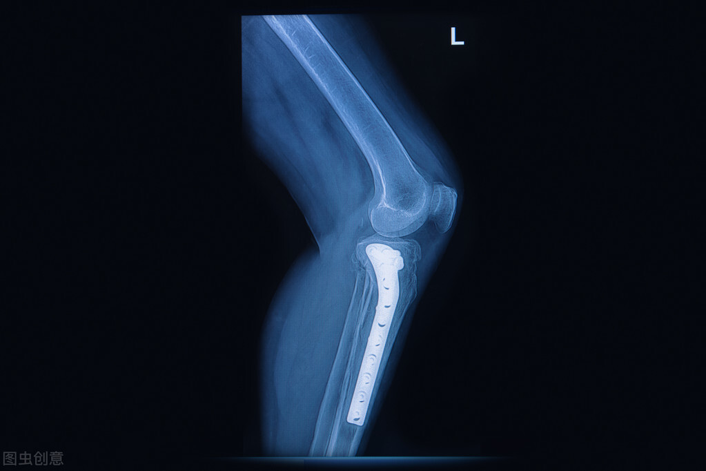 路医生说丨手术放进去的钢针钢板，要不要取？你想知道的都在这里