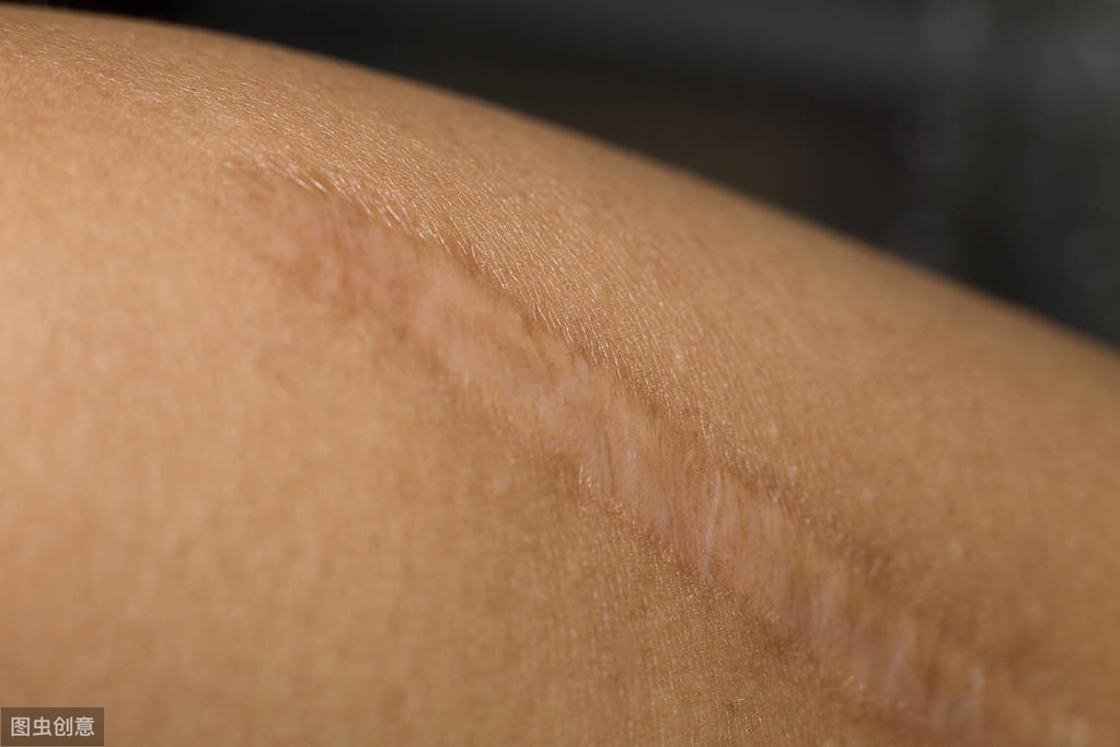 疤痕影响美观，这些治疗用药你了解吗？