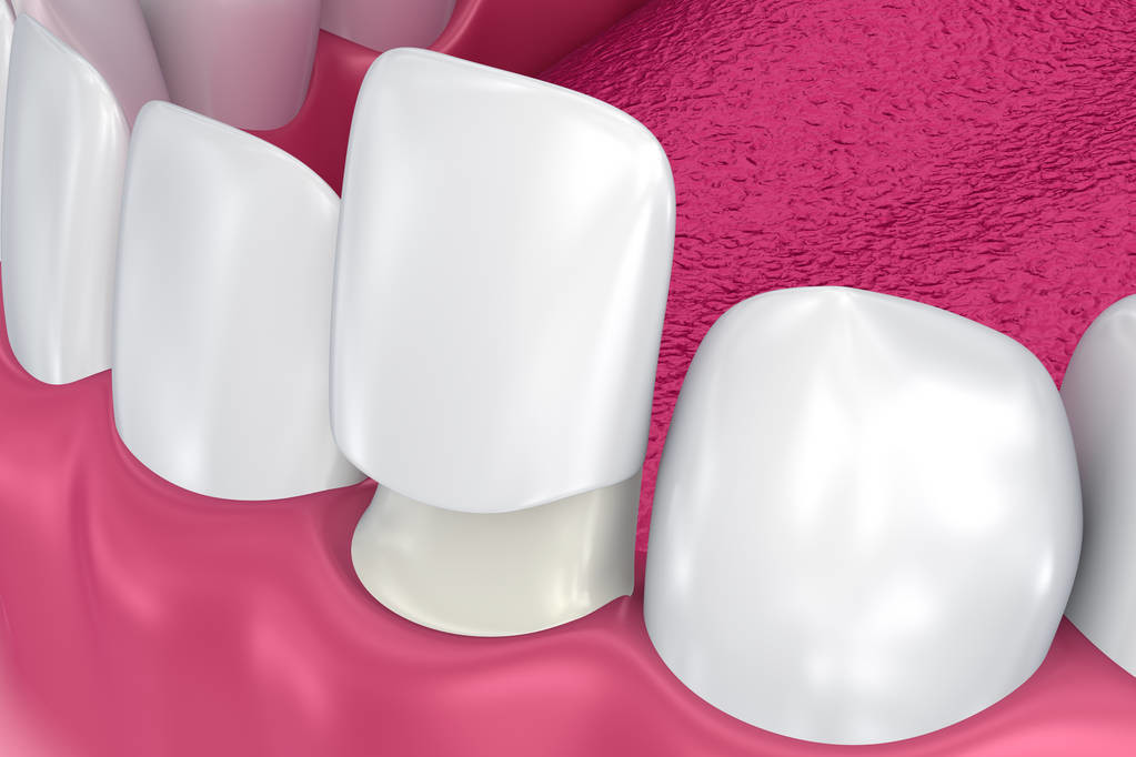 牙医解答大家对洗牙的几个常见误会，洗牙其实没那么可怕