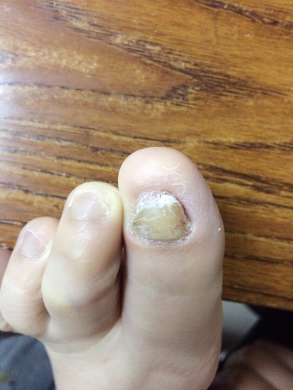 灰指甲的初期症状 灰指甲啥样子图片-佳迪双