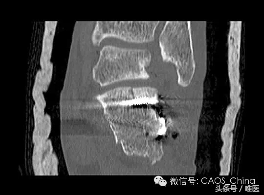 关节镜辅助下复位+经皮螺钉内固定术-骨医小灶第七期III