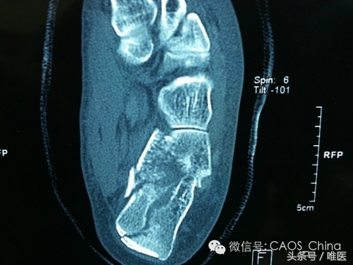 关节镜辅助下复位+经皮螺钉内固定术-骨医小灶第七期III