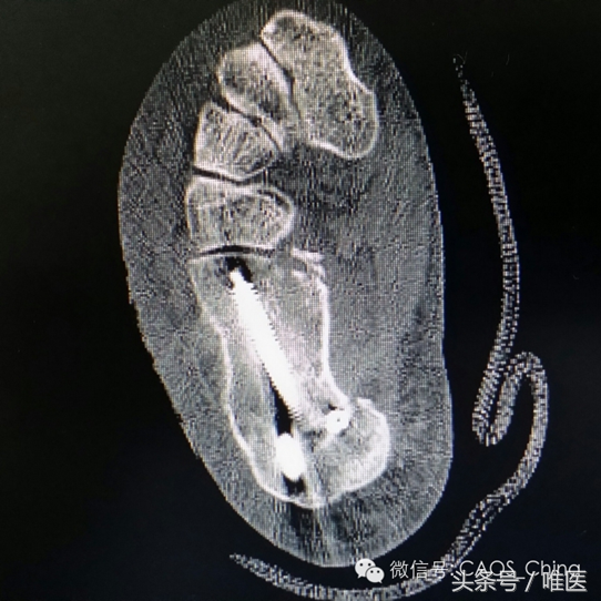 关节镜辅助下复位+经皮螺钉内固定术-骨医小灶第七期III