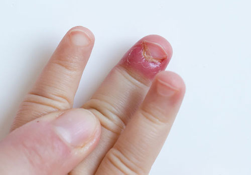 指甲突然变黄,发脆,凹陷,有竖线,是生病的征兆吗?