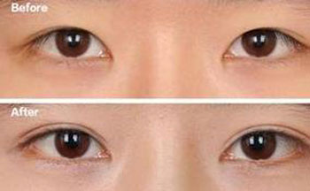 双眼皮有这4种做法，除了这4种，其他都是骗人的！