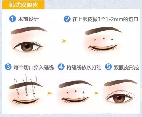 双眼皮有这4种做法，除了这4种，其他都是骗人的！