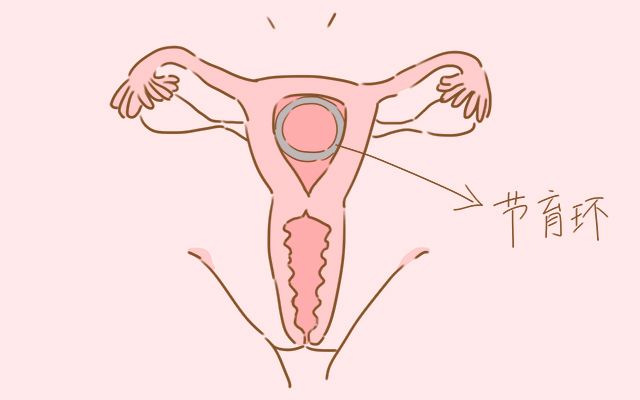 而那些已经做过上环手术的女性想要怀孕,就必定先要进行取环手术,那么