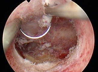 宫颈粘连手术多少钱「宫颈粘连手术后还会粘连吗」-友友