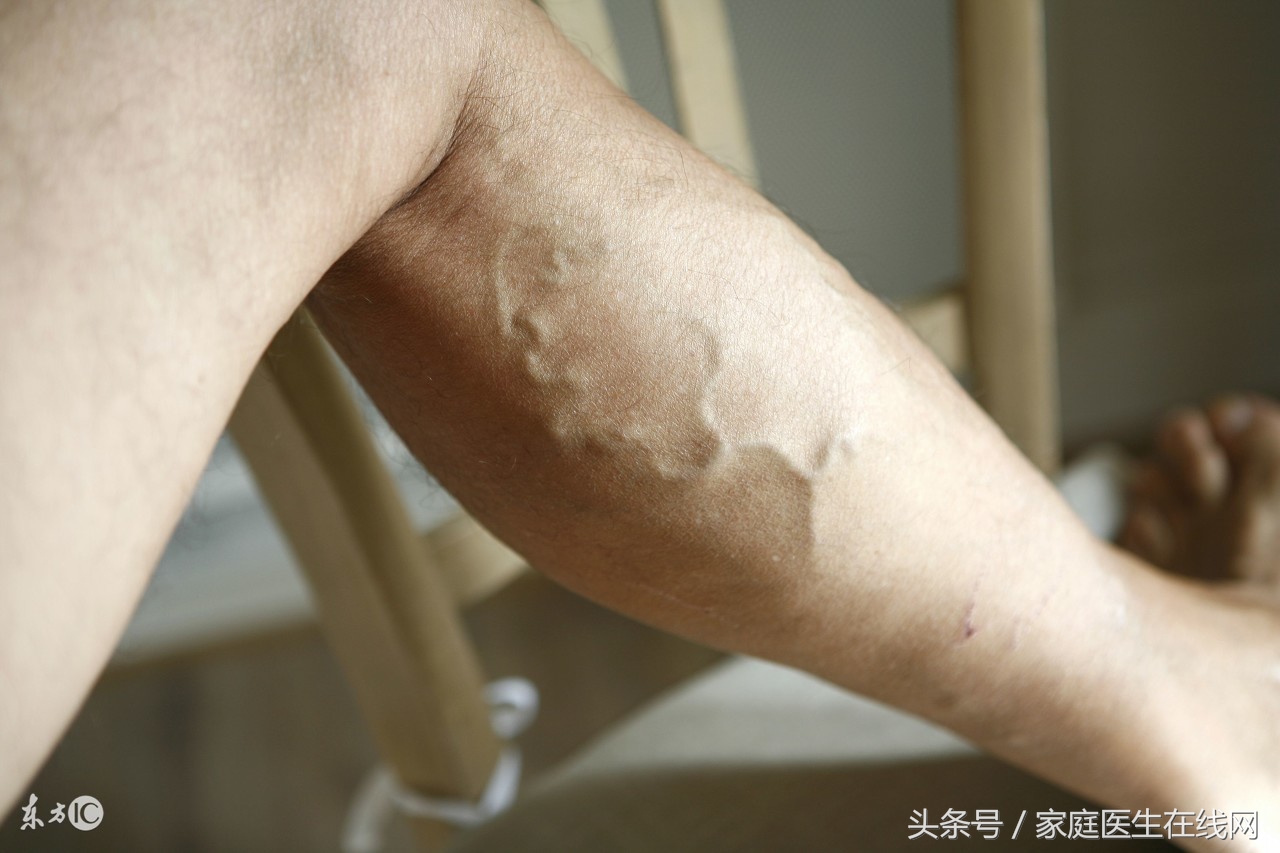这些部位"青筋暴突",暗示身体出现大毛病了!