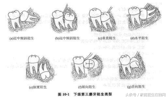 智齿没拔干净会继续长吗「智齿牙根没拔干净会怎么样」