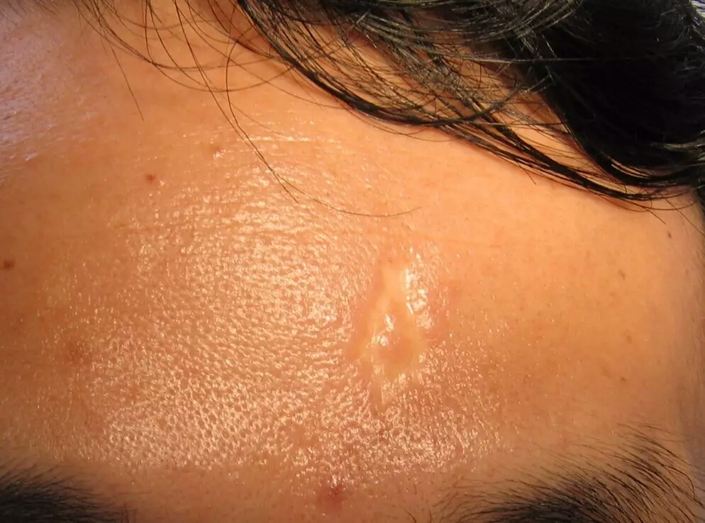 阑尾炎,剖腹产术后手术疤痕怎么破?来看整容外科医生怎样回答