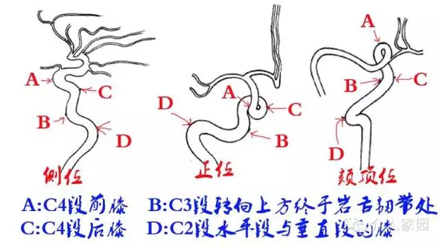 DSA图文详解之颈内动脉分段