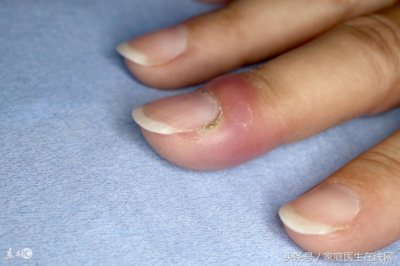 指甲容易断,老是留不长?可能是出现这个问题了!