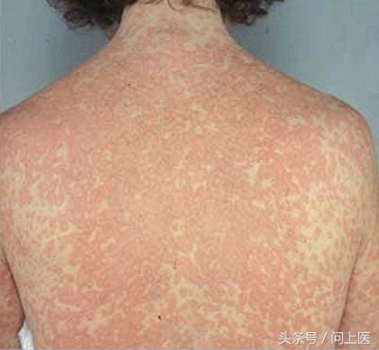 青霉素过敏该如何治疗和用药?