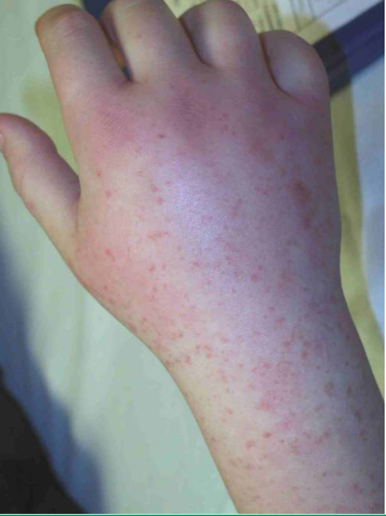 过敏性紫癜有什么特征?如何才能不误诊