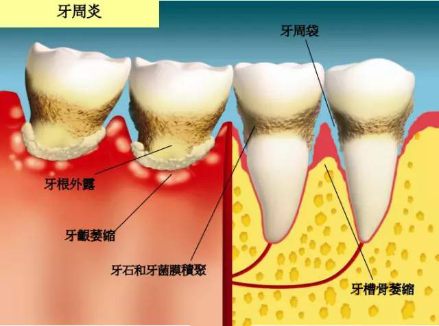 牙齒鬆動修復多少錢牙齒鬆了還能恢復嗎