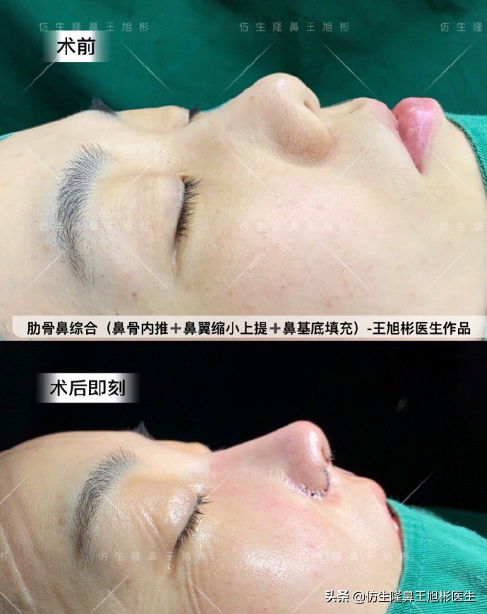 如何定义短鼻，短鼻延长后的改变有多大？