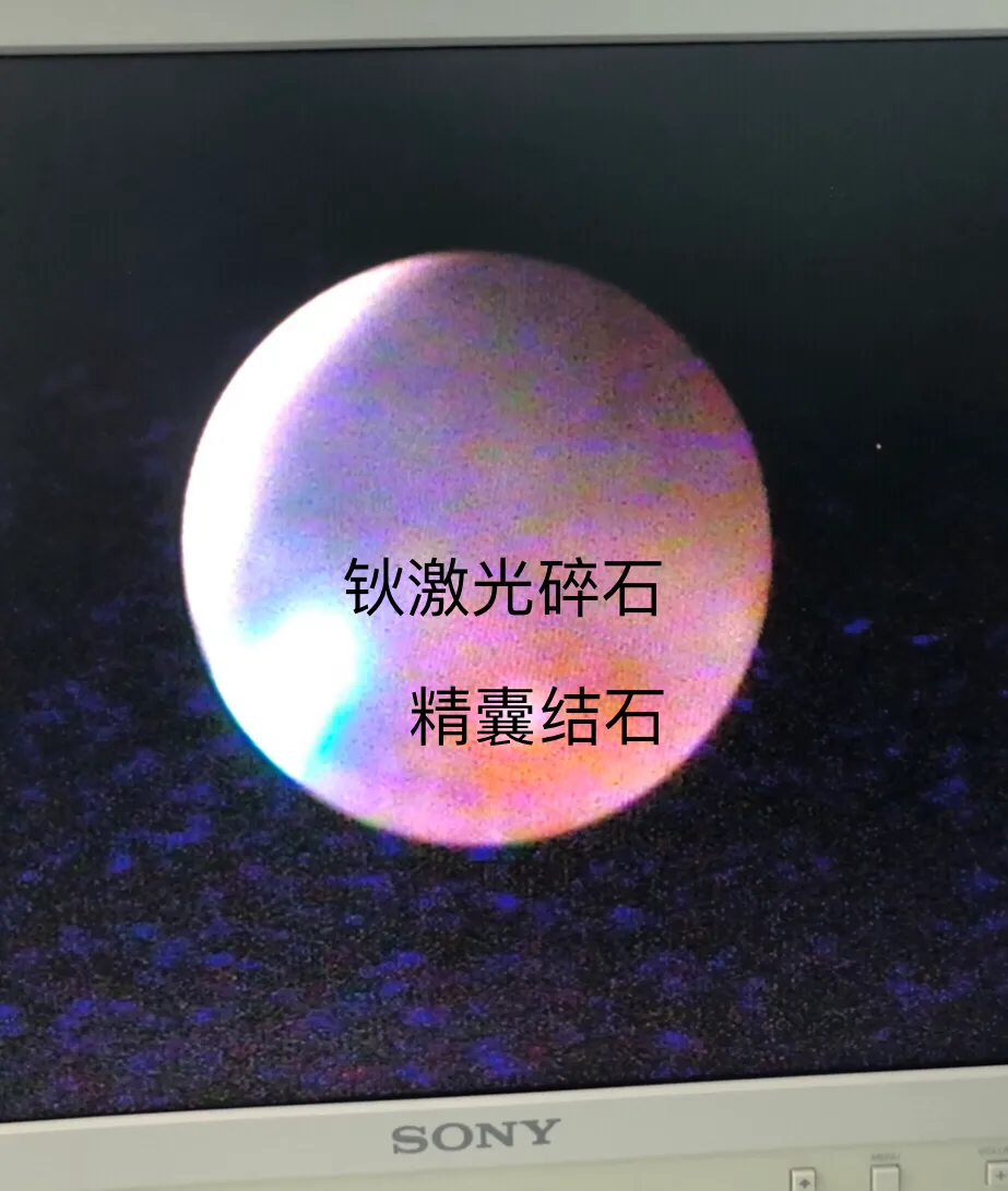 男科手术探秘6:精囊炎血精、精囊结石和精囊镜手术、钬激光碎石