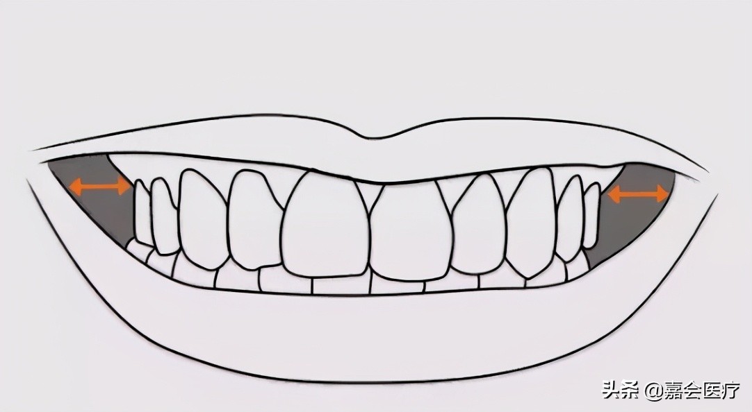 已经成年，还能做牙齿矫正吗？口腔科医生告诉你答案