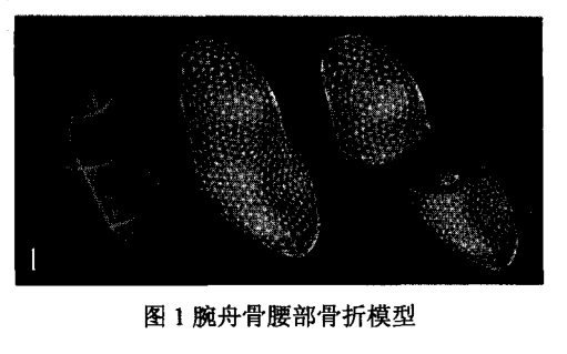 掌侧逆行固定治疗腕舟骨腰部骨折三维有限元分析